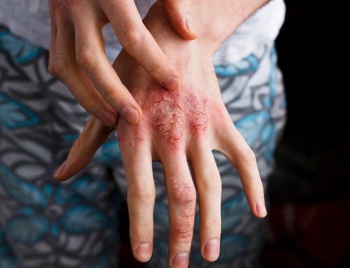 Eczema Atopic Dermatitis