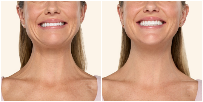 Before and after of botox treating neck