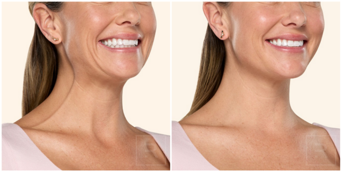 Before and after of botox treating neck