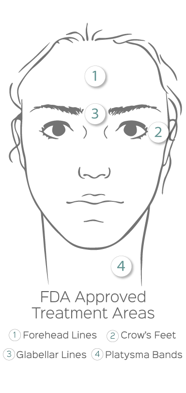 FDA Approved treatment areas on a face map infographic