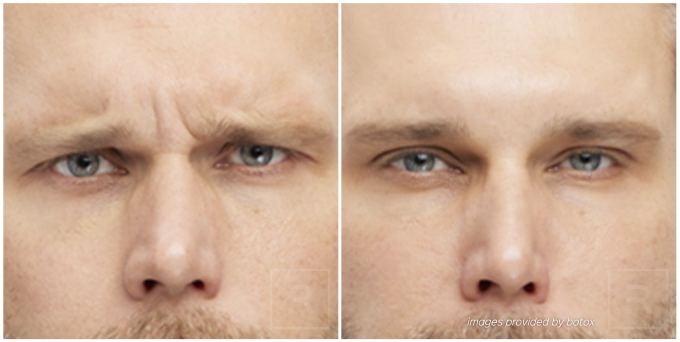 Before and after Botox results from Austin patient.