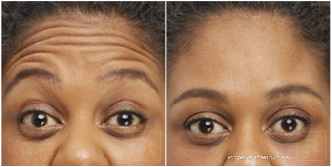 botox before and after forehead lines
