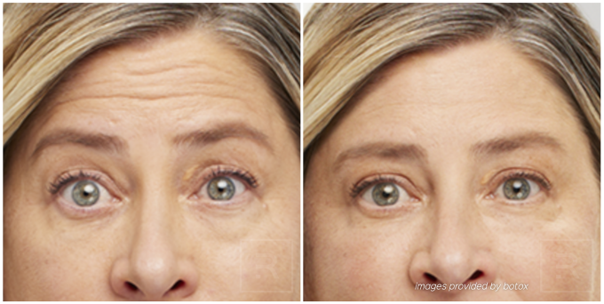 Before and after Botox results from Austin patient.