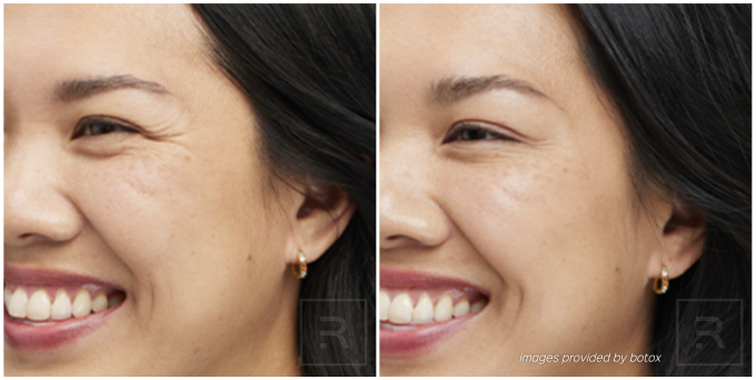 botox before and after crow's feet
