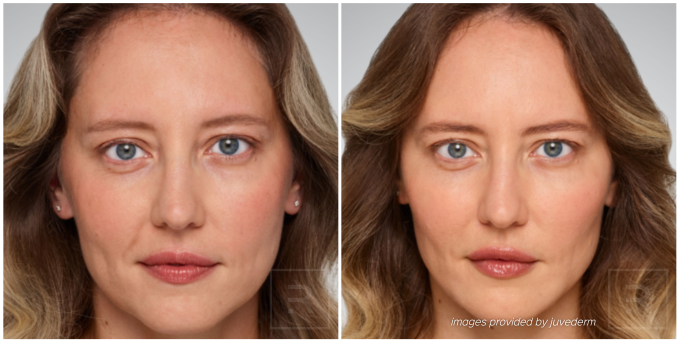 juvederm before and after woman