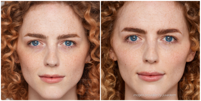 juvederm before and after woman