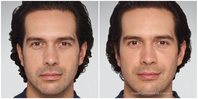 juvederm before and after man