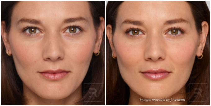 juvederm before and after woman