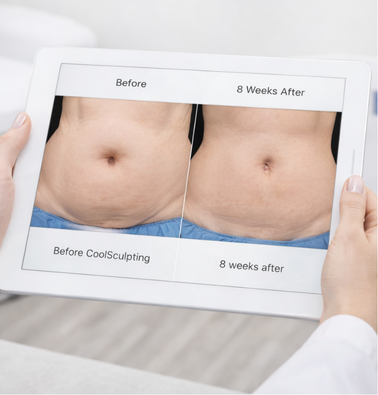 Printed CoolSculpting Elite before and after abdomen comparison shown during consultation.