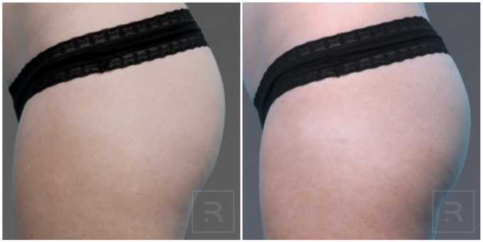 Before and after results from cooltone