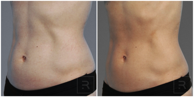 Before and after results from cooltone