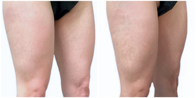 Before and after results from cooltone