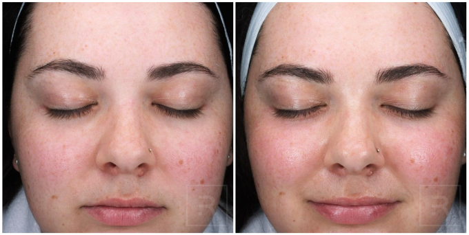 Womans face treated with diamond glow before and after