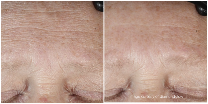 Older woman image of forehead before and after treatment