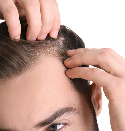 Man with dandruff in his hair