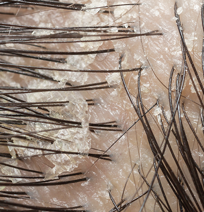 Close up of dandruff