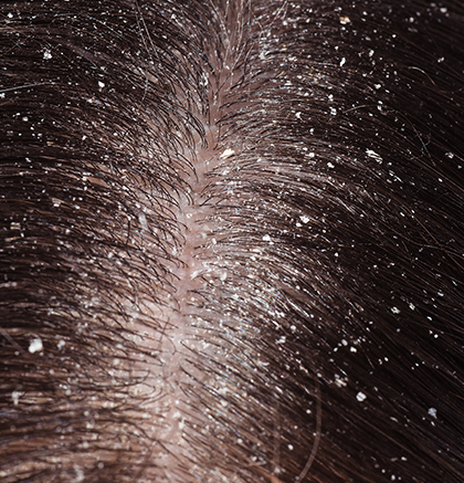Close up of dandruff