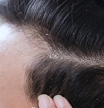 Close up of dandruff