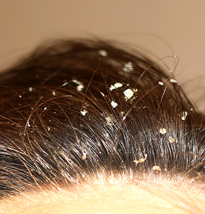 Close up of dandruff