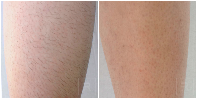 Laser hair removal on legs before and after at Revelus Dermatology