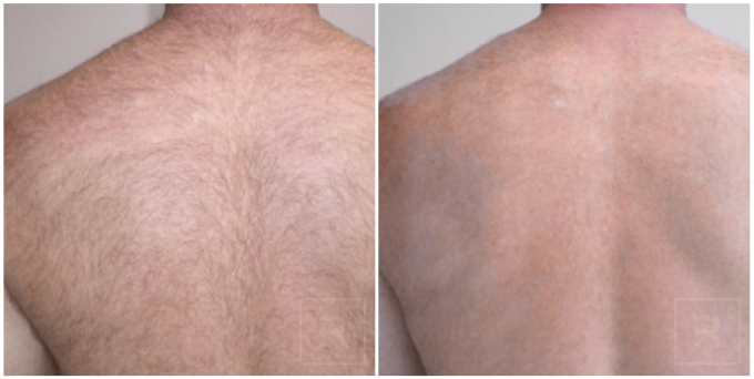 Laser hair removal results on a man’s back at Revelus Dermatology