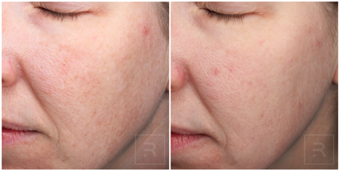 melange peel hyperpigmentation treatment before and after results