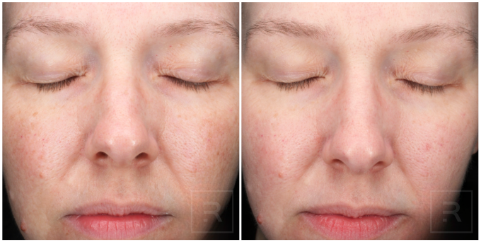 melange peel results for stubborn pigmentation and uneven skin tone