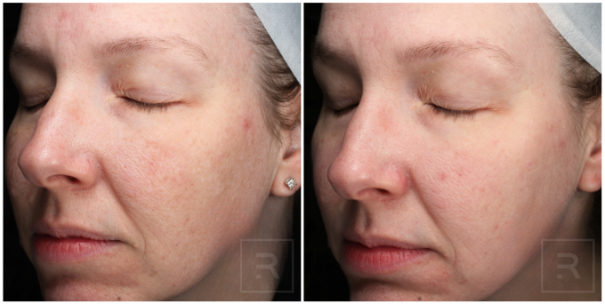melange peel before and after for facial hyperpigmentation treatment
