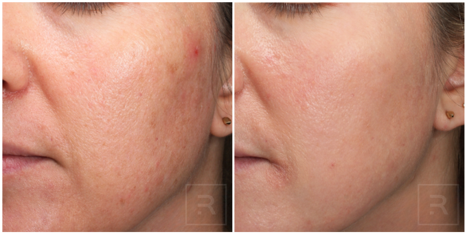 chemical peel results improving early skin texture and discoloration