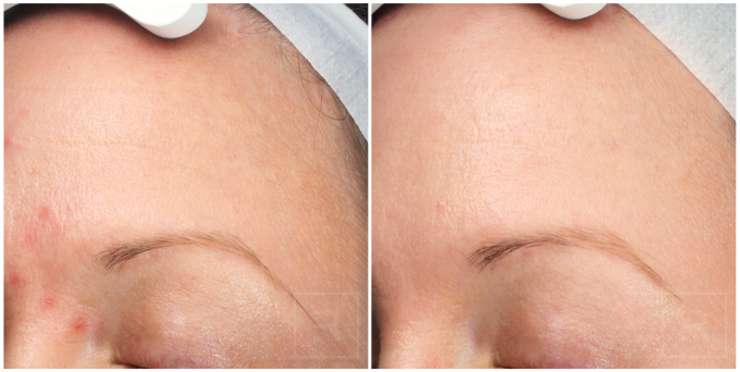 chemical peel before and after for mild pigmentation and uneven skin tone