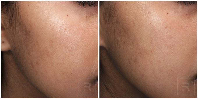 Precision Peel Plus before and after showing improved skin tone and reduced pigmentation on cheek