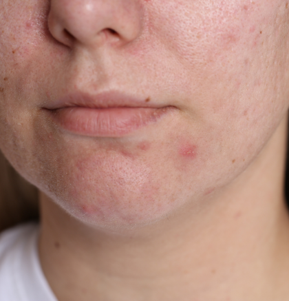 Close-up of inflammatory acne with red pimples on the chin and lower face