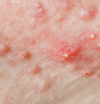 Close-up view of a red inflamed acne pustule on facial skin