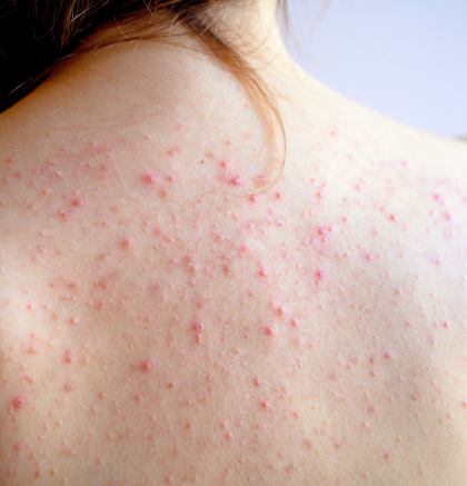 Red acne breakouts on the upper back and shoulders