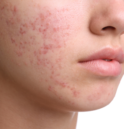 Moderate acne breakouts on the cheek and lower face