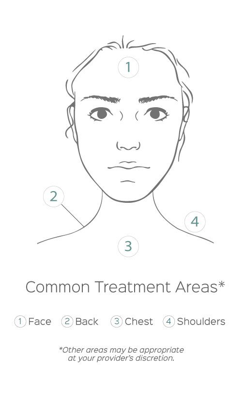 Common treatment areas for chemical peels including face neck chest and shoulders