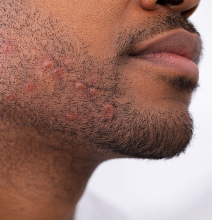 Pseudofolliculitis barbae with ingrown hairs and bumps on jawline and chin