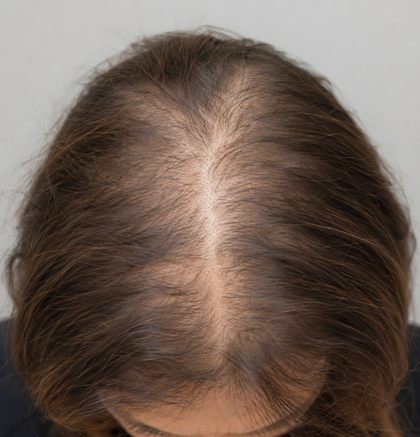 Female pattern hair loss with widened part and visible scalp from thinning hair
