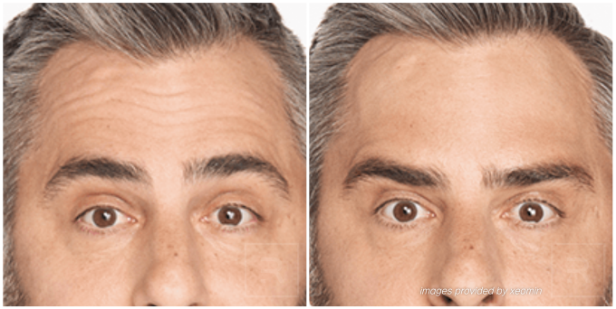 xeomin before and after forehead lines