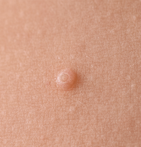 Close-up of molluscum contagiosum bumps on skin