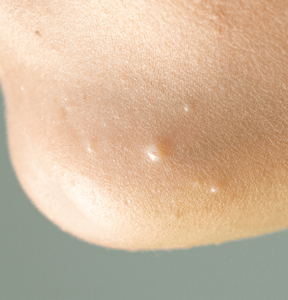 Close-up of molluscum contagiosum bumps on skin