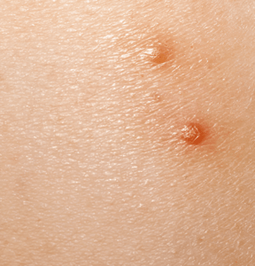 Close-up of molluscum contagiosum bumps on skin