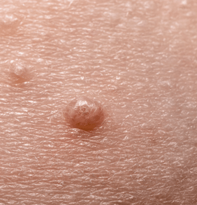 Close-up of molluscum contagiosum bumps on skin