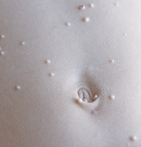 Close-up of molluscum contagiosum bumps on skin