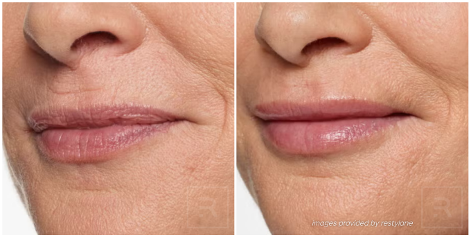 Restylane filler before and after photos showing smoother skin and restored facial volume.