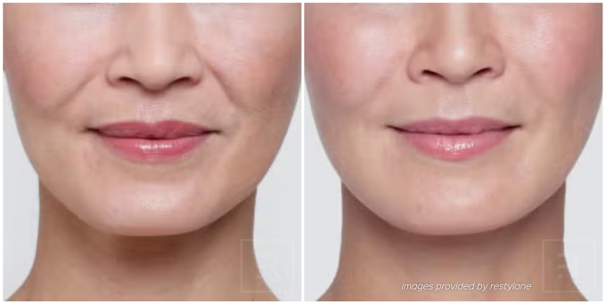 Restylane filler before and after photos showing smoother skin and restored facial volume.