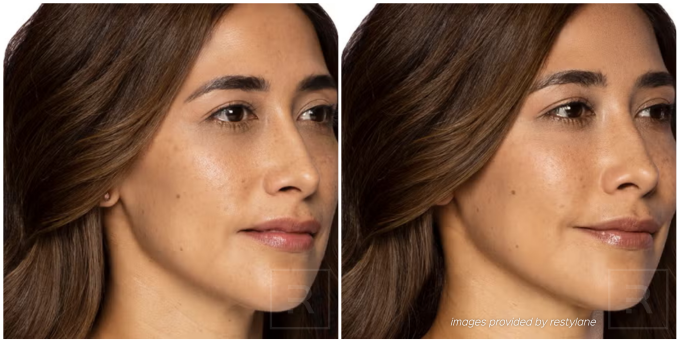 Restylane filler before and after photos showing smoother skin and restored facial volume.