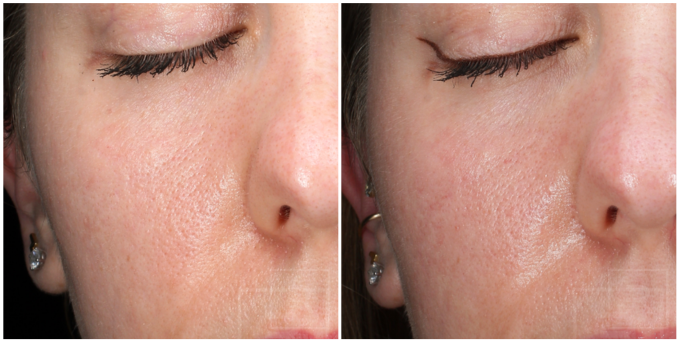 photofractional laser treatment improving pores and skin texture