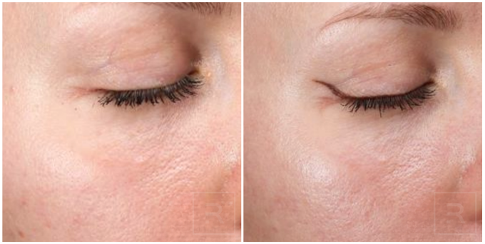photofractional laser before and after for redness and skin texture