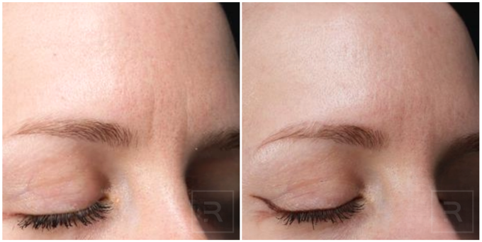 photofractional laser before and after for skin texture and tone